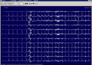 60 Hz Interference on EKG Holter Unit